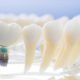 implantes dentales tipos