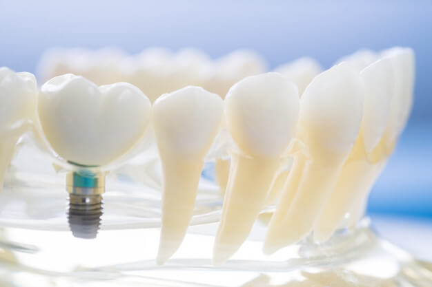 implantes dentales tipos