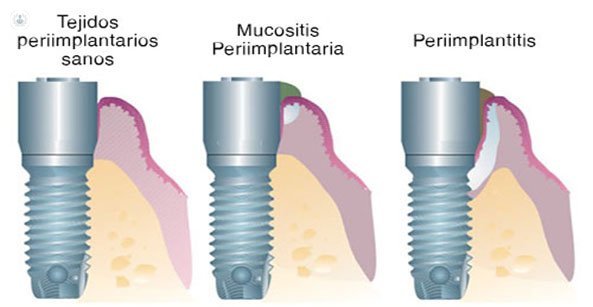 periimplantitis