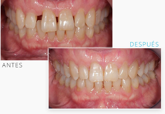 tratamiento de diastema dental con ortodoncia