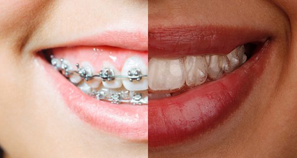 Ortodoncia invisible vs ortodoncia convencional