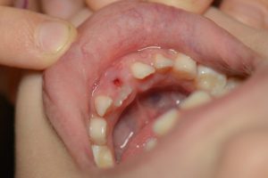 Avulsión dental, qué es y por qué sucede