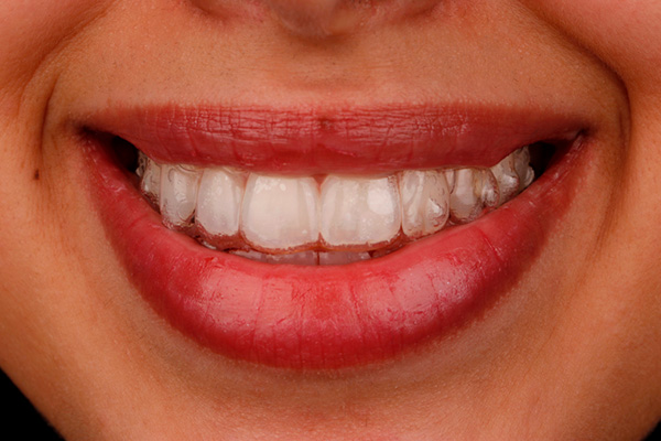 Importancia del estudio de ortodoncia para empezar con tu tratamiento