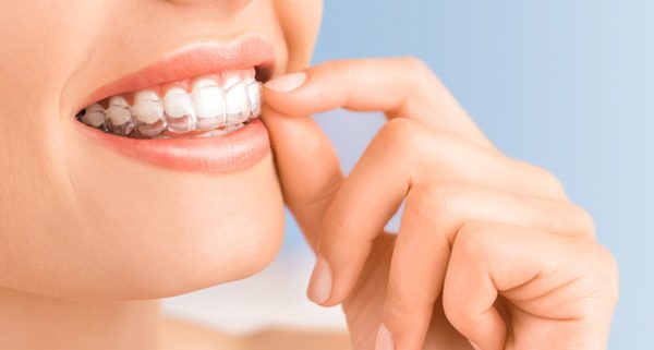 La ortodoncia con alineadores transparentes duele