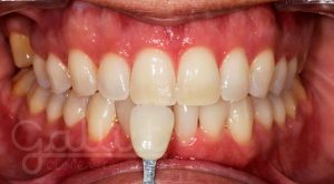 Blanqueamiento dental: mejora fácilmente la estética de tu sonrisa