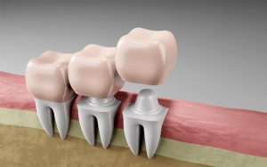 Qué es una funda dental y ventajas