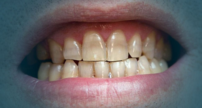 dientes amarillos tetraciclina