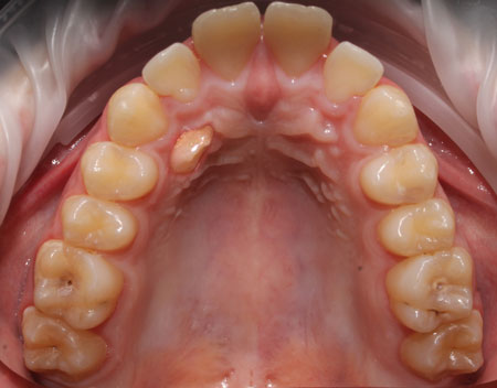 dientes en el paladar