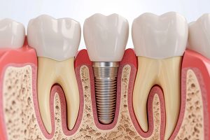 implante dental