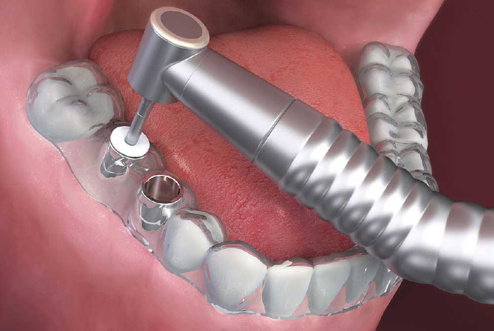 Colocación de implantes con cirugía guiada