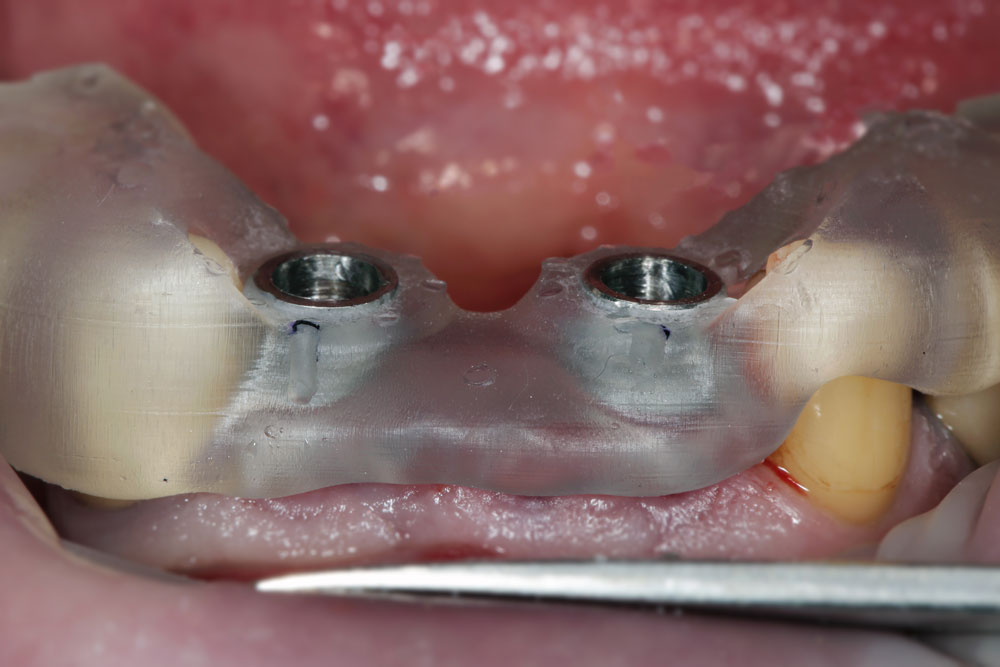 ferula quirurgica implantes dentales