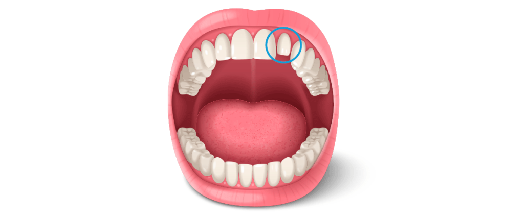 dientes pequeños microdoncia
