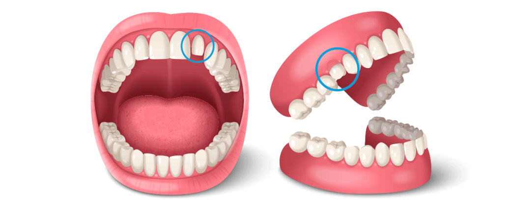 dientes pequeños