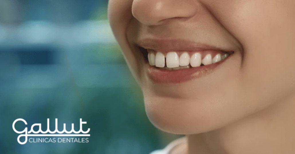 diastema