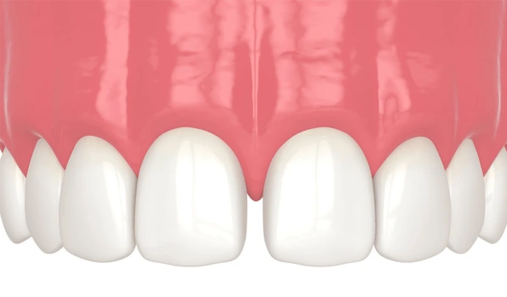 diastema dental