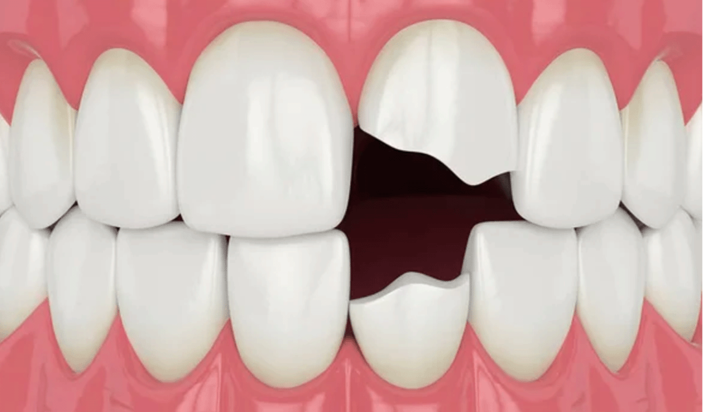 fractura dental