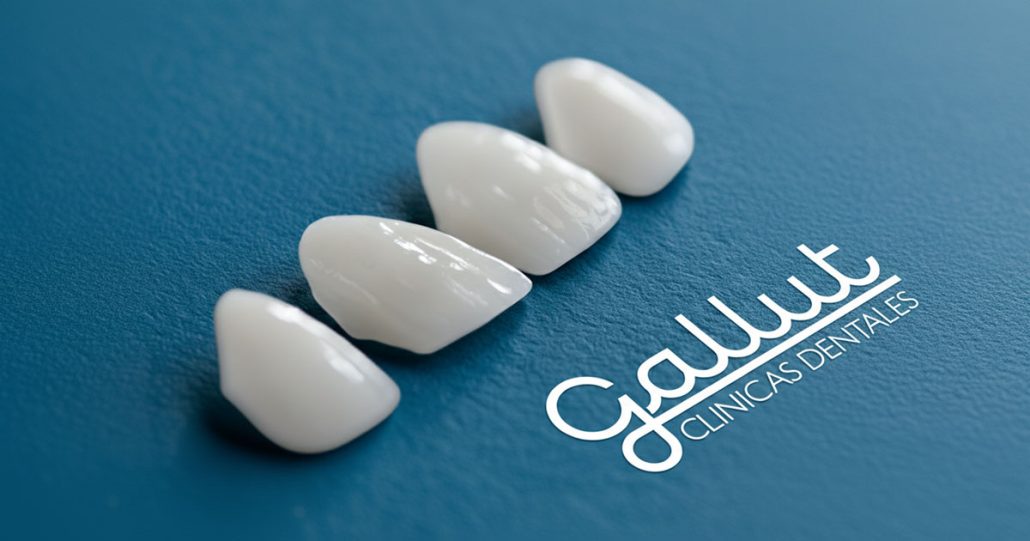 carillas de composite