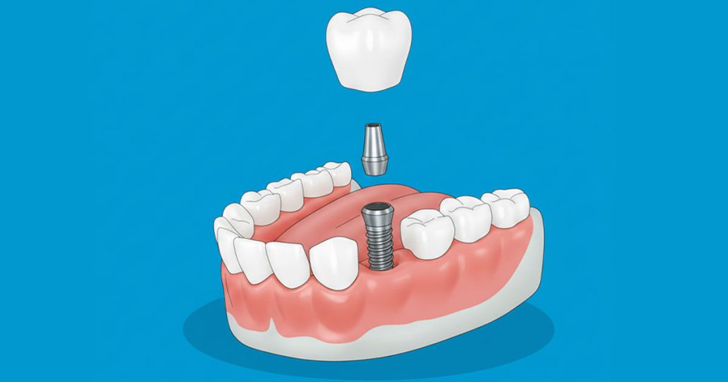 implantes con carga inmediata