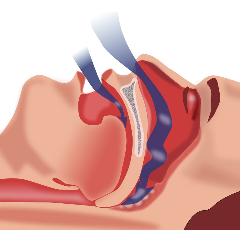 apnea obstructiva del sueño