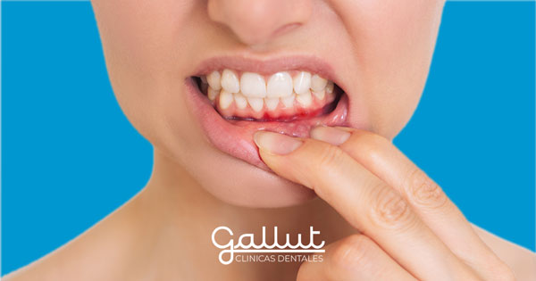 gingivitis avanzada