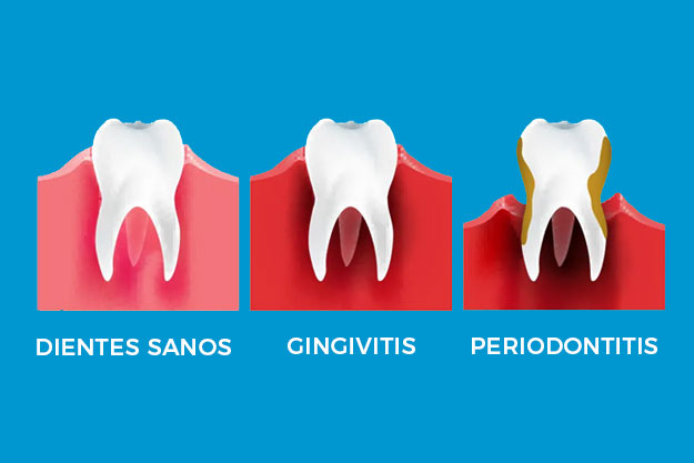 evolución de encias sanas a gingivitis avanzada