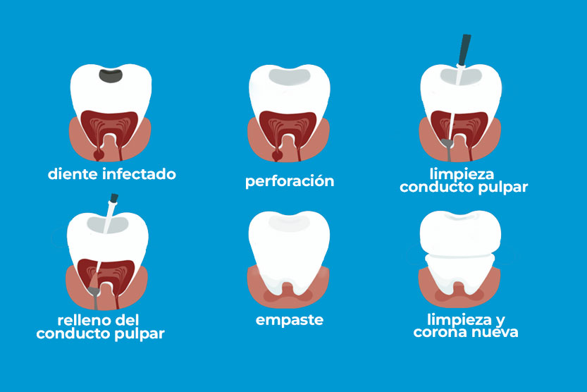 Endodoncia