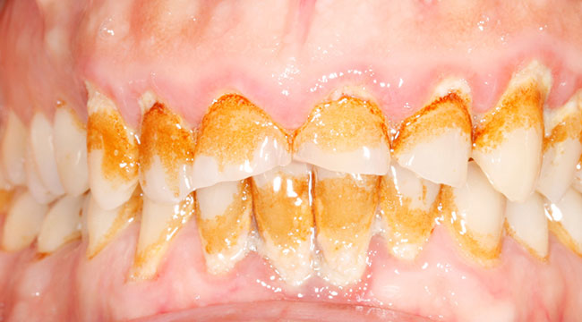 Caso multidisciplinar: ortodoncia invisible, implante dental, incrustaciones, blanqueamiento dental