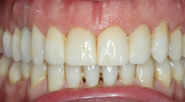 Caso multidisciplinar: ortodoncia invisible, implantes, incrustaciones, blanqueamiento dental (después)