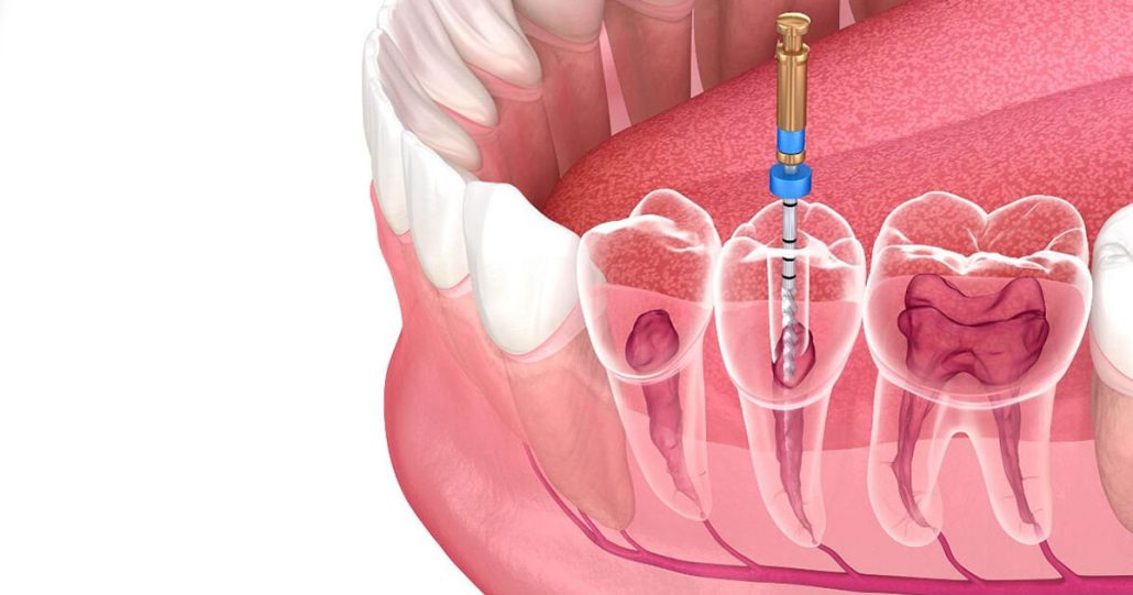 Endodoncia