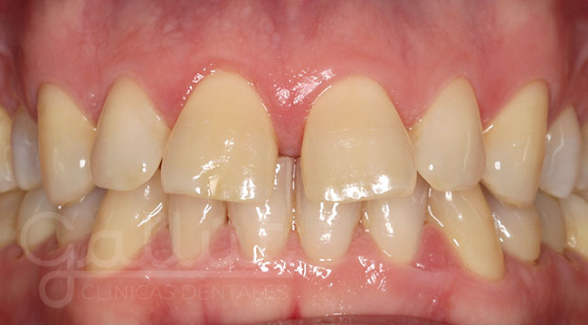 Separación dental
