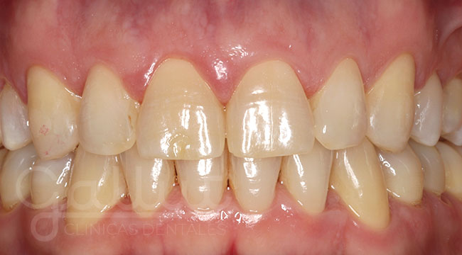 Separación dental