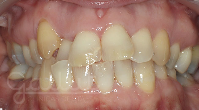 Ortodoncia + Blanqueamiento + Reconstrucción estética