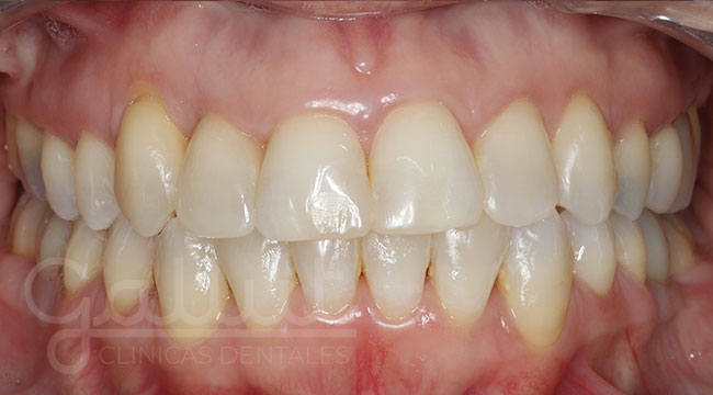 Ortodoncia + Blanqueamiento + Reconstrucción estética