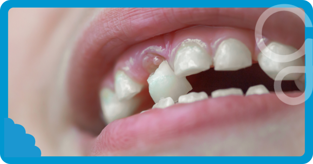 movilidad dental