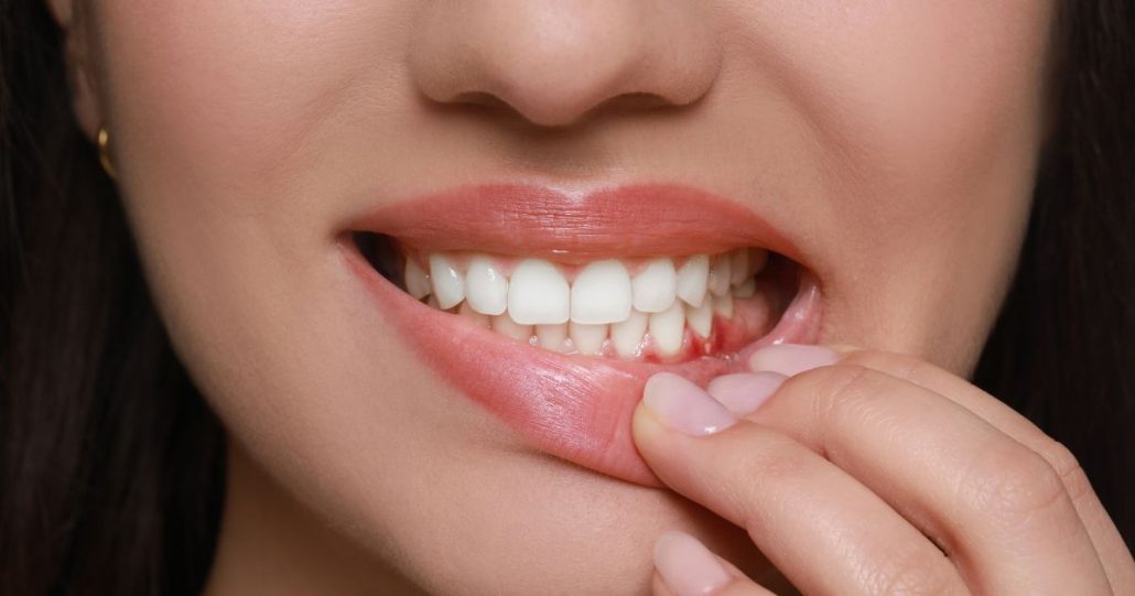 Bolsa periodontal