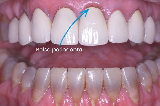 bolsa periodontal