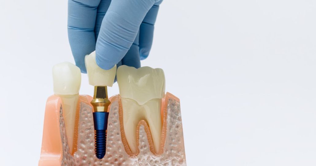 Osteointegración