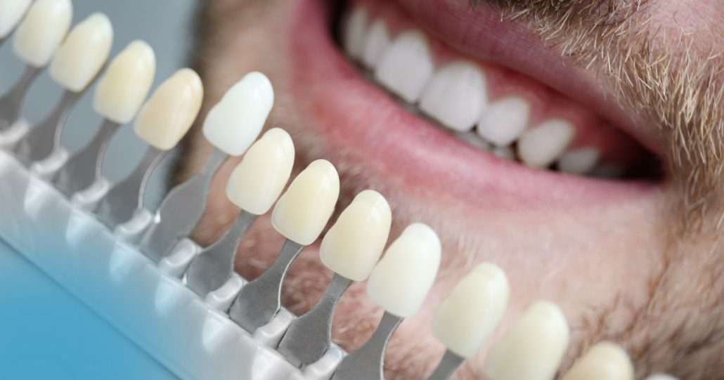 diseño de sonrisa con carillas